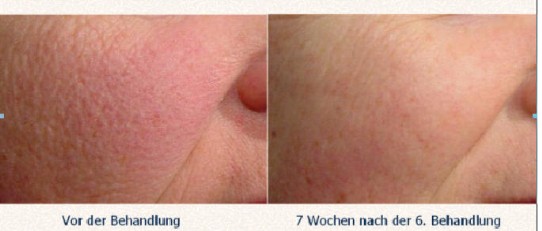 Laserzentrum Dr Med Walter Bayard Spezialarzt Fur Haut Und Venenleiden Angiologie Laserzentrum Und Kosmetische Dermatologie